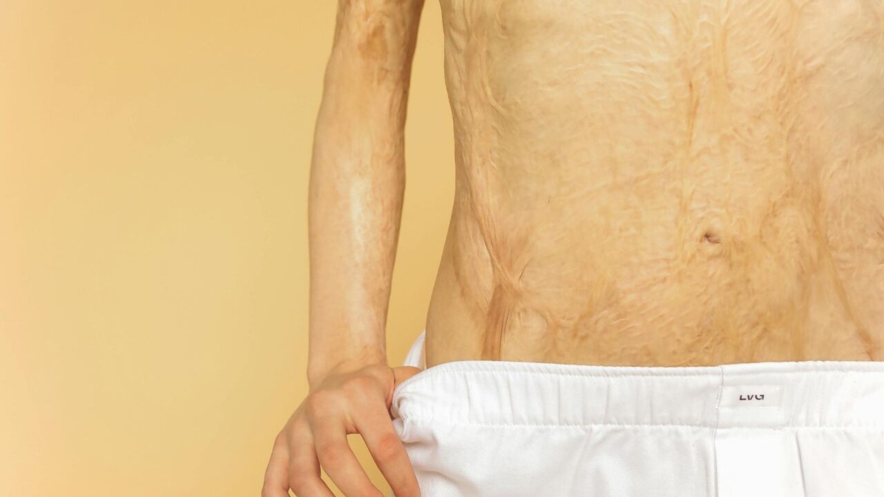 Burn Injuries from Gas Explosions in Fort Worth: Legal Options for Victims